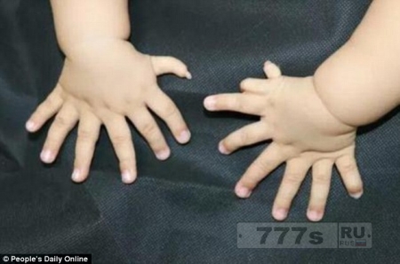 Китайский мальчик, родившийся с 15 пальцами на руках и 16 на ногах, будет прооперирован