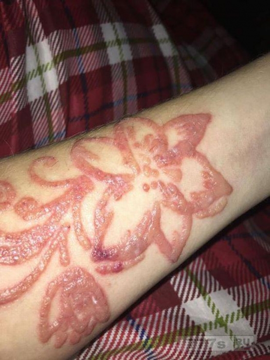 Женщина получила ужасные ожоги на руке, сделав черную временную татуировку.
