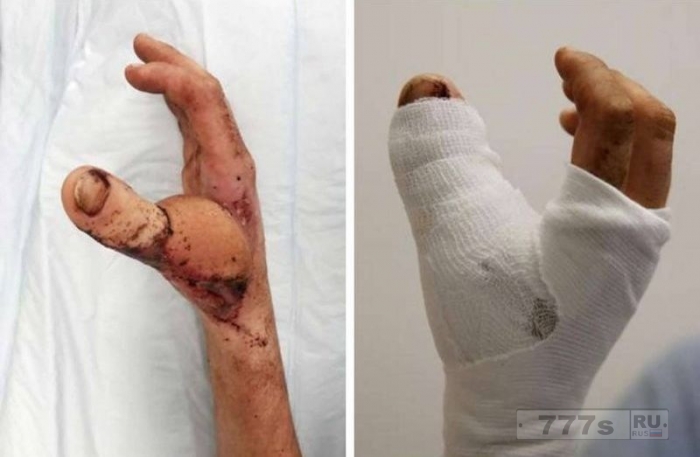 Операция по пересадке пальцев с ноги на руку