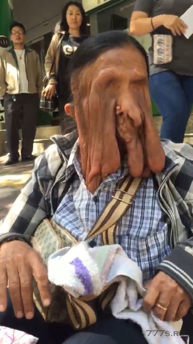 Бабушка с «текущим» лицом, из-за которого она ослепла, отказывается от операции, потому что боится умереть на операционном столе