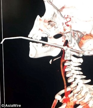 Мальчик выжил после того, как 14-сантиметровая спица для вязания пробила его горло и застряла в черепе