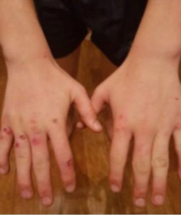 У мальчика диагностировали первый случай коровьей оспы через более чем 10 лет после того, как теленок почесал его руку