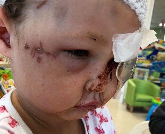 4-летняя девочка, чуть не лишилась черепа из-за «дьявольской собаки», когда она напала на неё