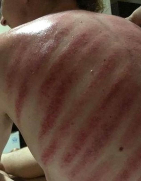 Турист на Бали пошел на расслабляющий массаж, который закончился ужасными красными следами на спине