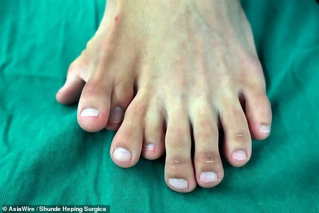 21-летний китаец с девятью пальцами на одной ноге подвергается операции, чтобы удалить лишние пальцы